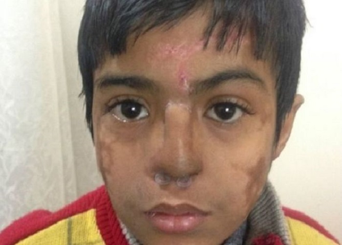 Indian doctors grow new nose on boy`s forehead